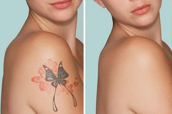 Что происходит при лазерном удалении татуировки?