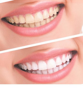 Отбеливание зубов системой ZOOM: особенности и преимущества