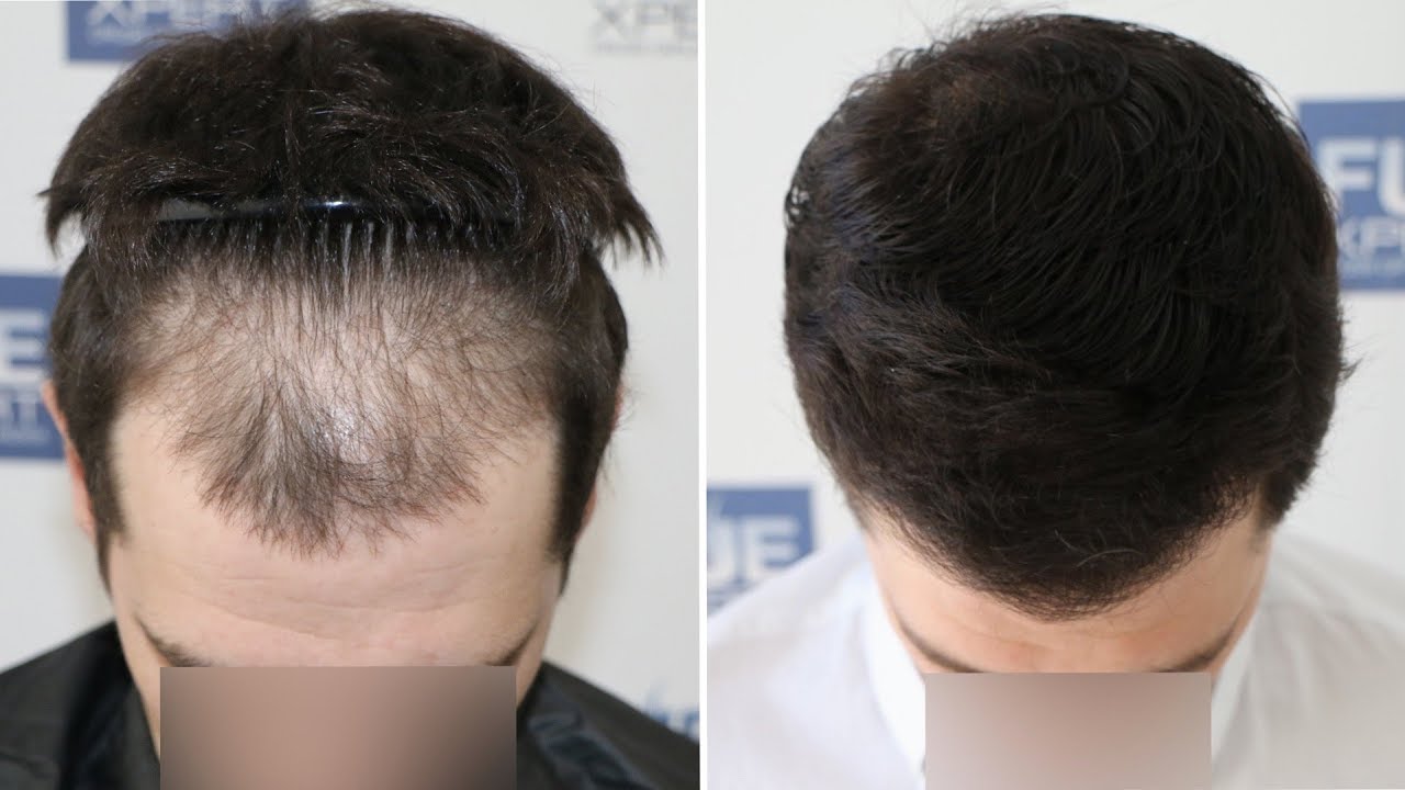 Пересадка волос для мужчин: особенности и преимущества