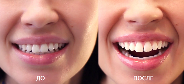 Особенности лазерного отбеливания зубов